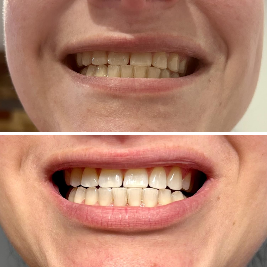 Teeth Whitening Strips (21 Strips)