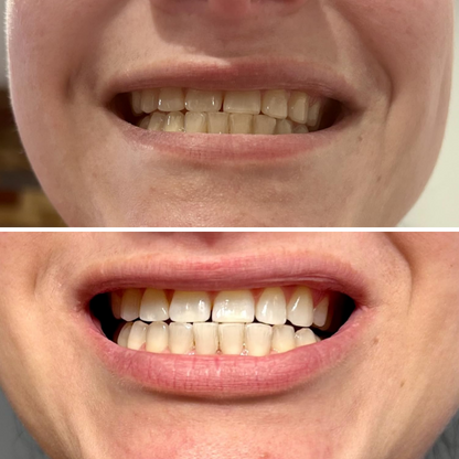 Teeth Whitening Strips (21 Strips)
