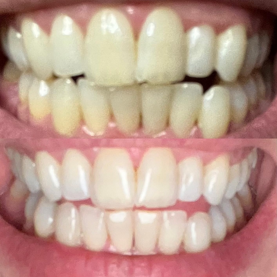 Teeth Whitening Strips (21 Strips)