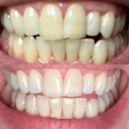 Teeth Whitening Strips (21 Strips)