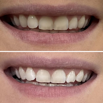 Teeth Whitening Strips (21 Strips)