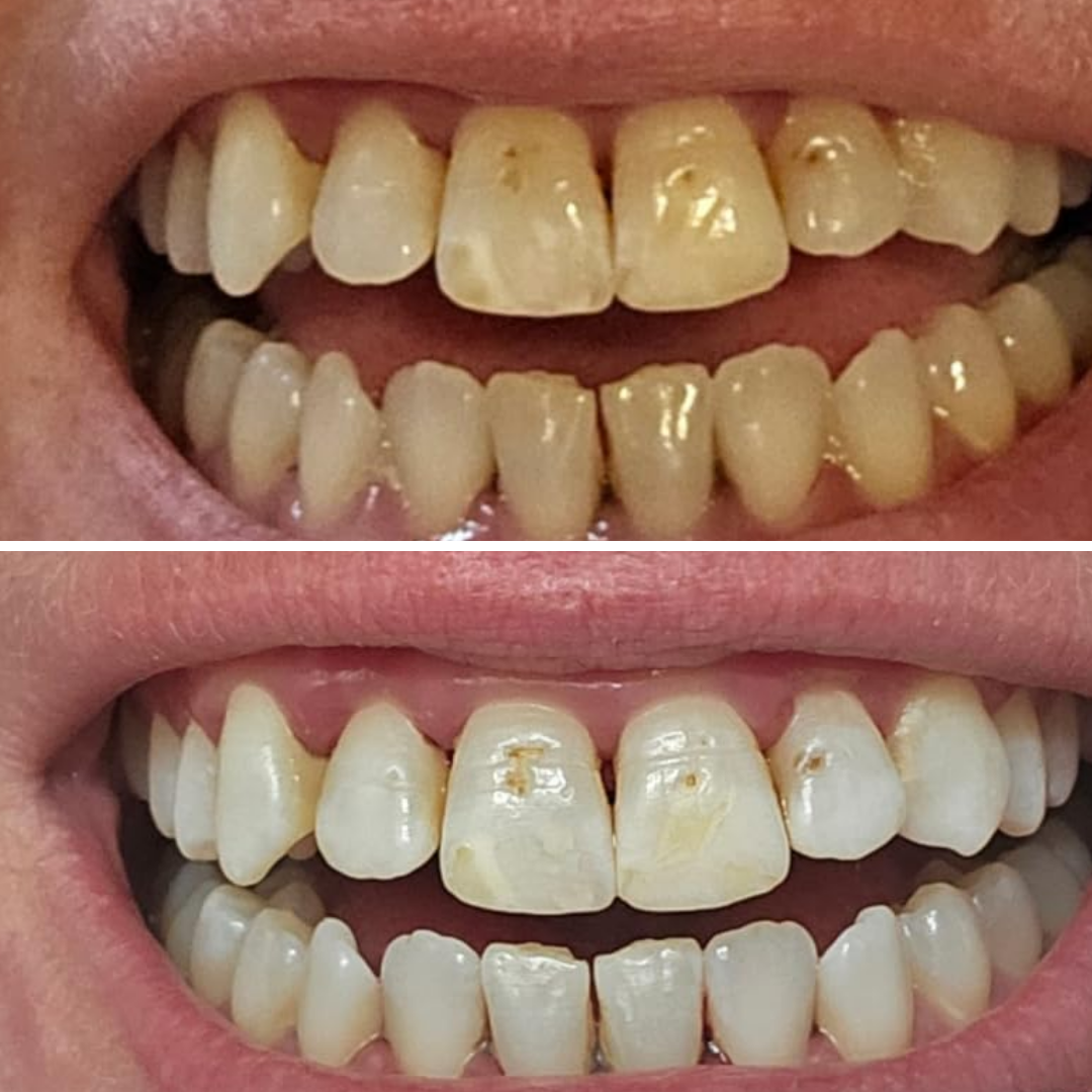 Teeth Whitening Strips (21 Strips)