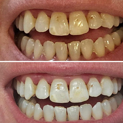 Teeth Whitening Strips (21 Strips)
