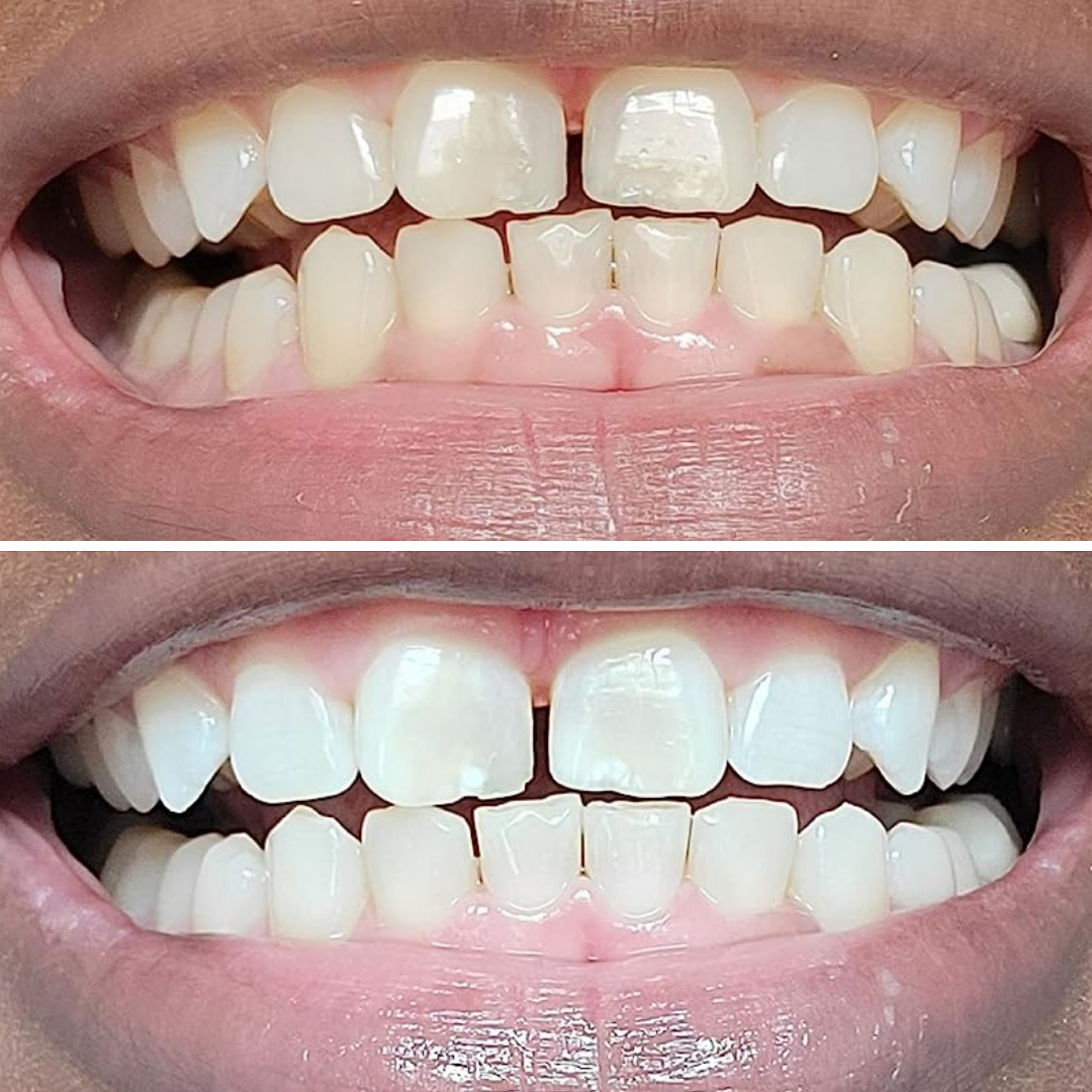 Teeth Whitening Strips (21 Strips)