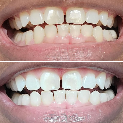 Teeth Whitening Strips (21 Strips)