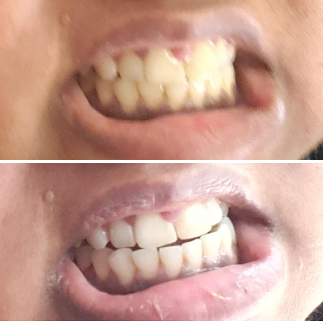Teeth Whitening Strips (21 Strips)