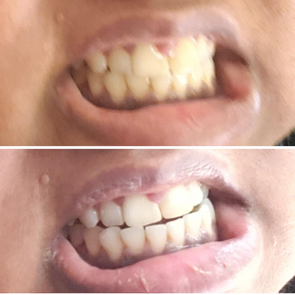 Teeth Whitening Strips (21 Strips)