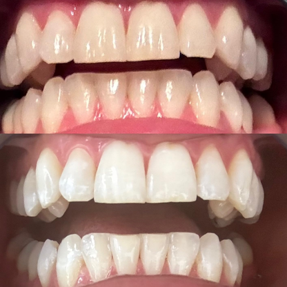 Teeth Whitening Strips (21 Strips)